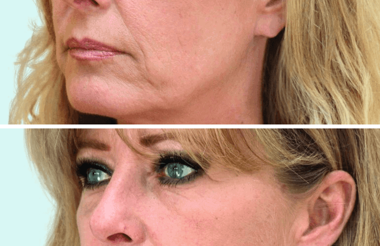 Vrouw voor- en na liquid facelift