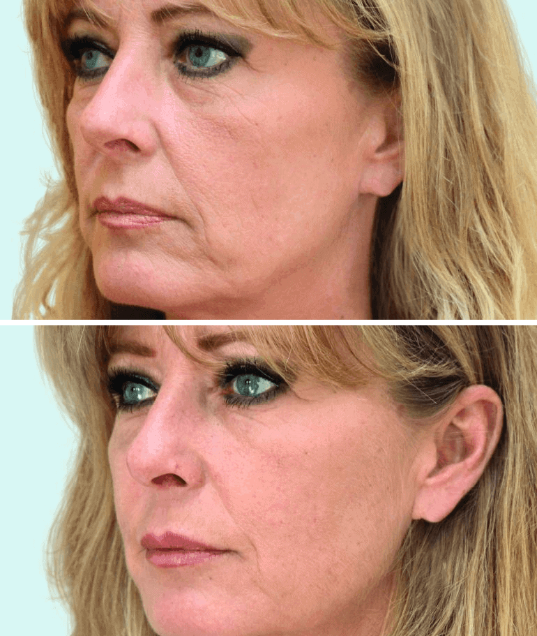 Vrouw voor- en na liquid facelift