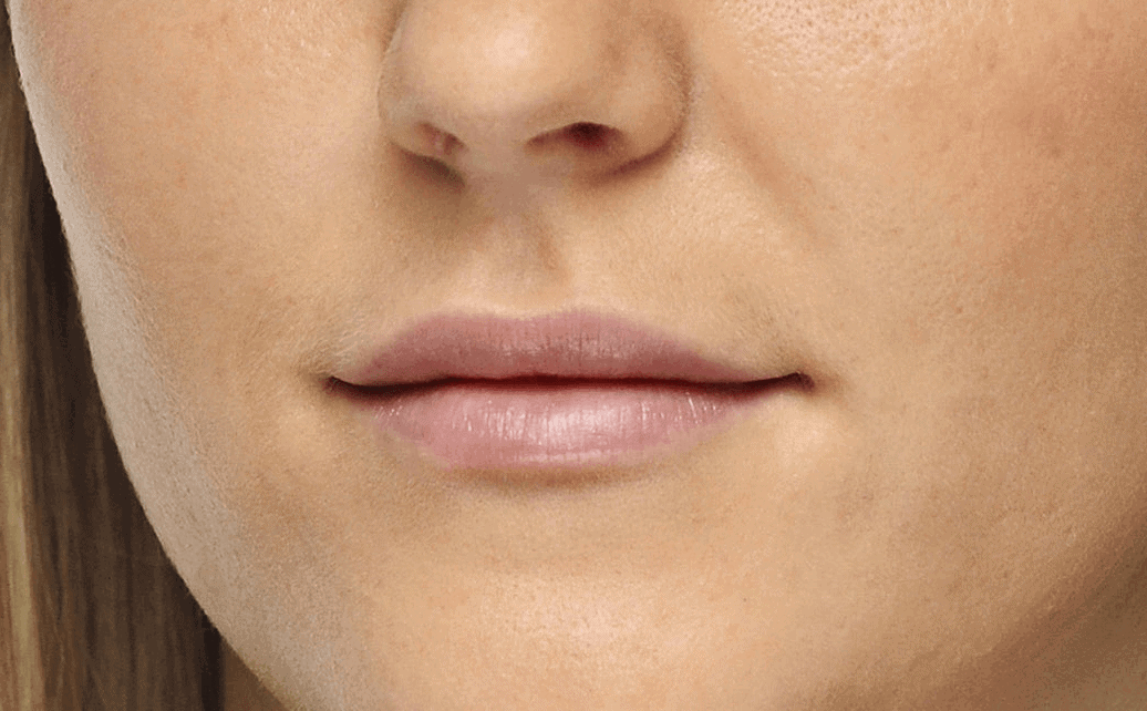Lippen opvullen