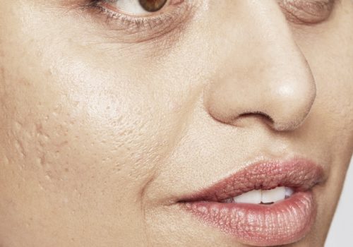 Acne littekens voor
