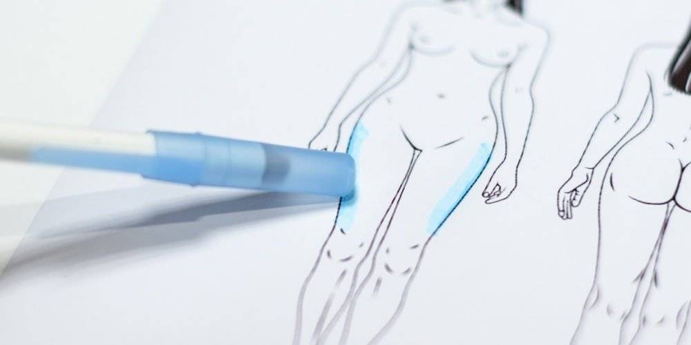 Behandelingen -Liposuctie - benen