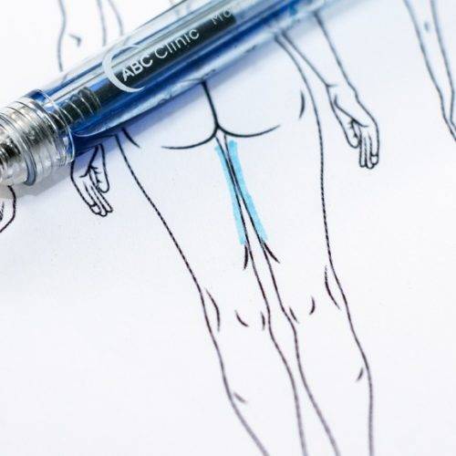 Behandelingen - liposuctie - binnenkant benen