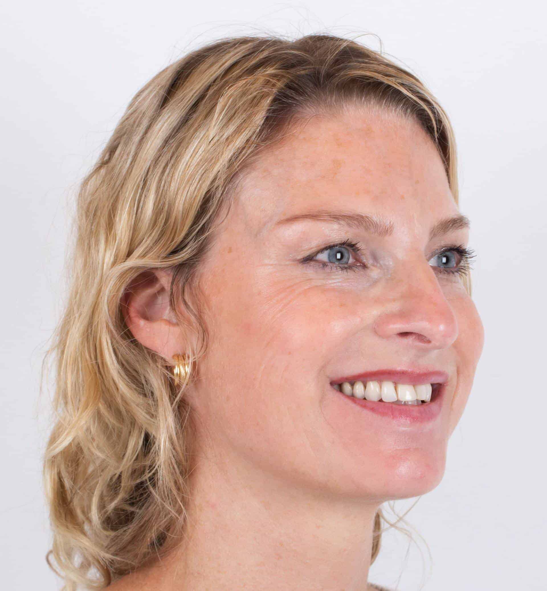 Botox Terneuzen