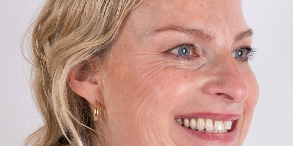 Botox en fillers Breda Inge