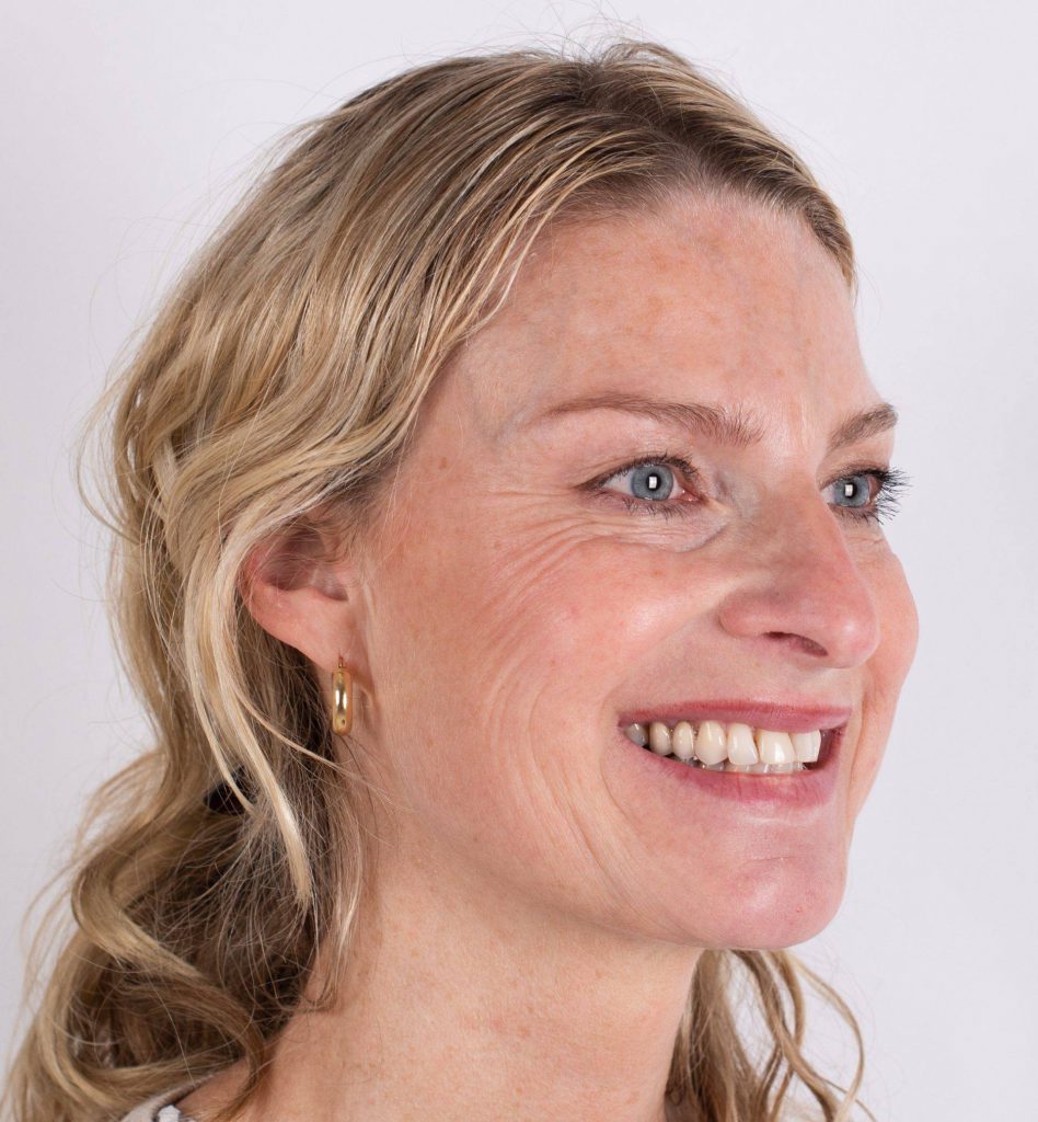 Botox en fillers Breda Inge