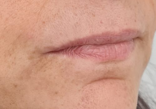 Botox en fillers marionetlijnen en hangende mondhoeken na