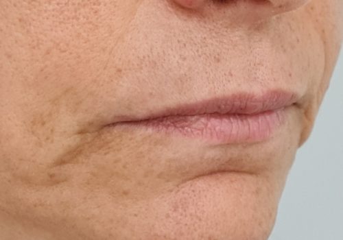 Botox en fillers marionetlijnen en hangende mondhoeken voor