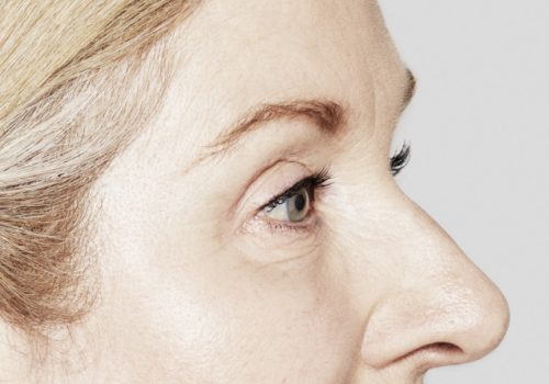 Botox fronsrimpels en kraaienpootjes na