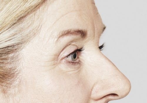 Botox fronsrimpels en kraaienpootjes voor