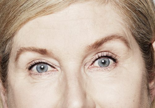 Botox fronsrimpels, kraaienpootjes en voorhoofd na