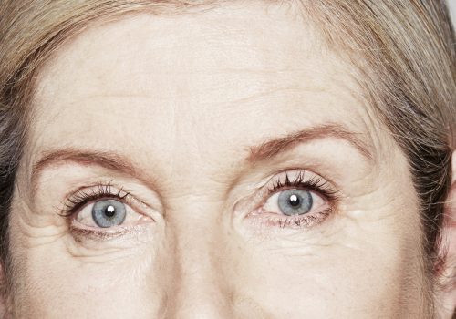 Botox fronsrimpels, kraaienpootjes en voorhoofd voor