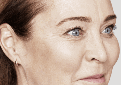 behandelingen - injectables - kraaienpootjes - Kraaienpootjes behandeling na
