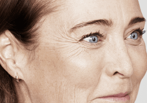 behandelingen - injectables - kraaienpootjes - Kraaienpootjes behandeling voor