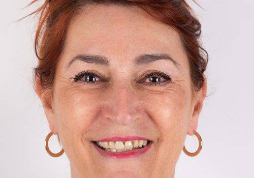 Lachrimpels verzachten met Botox