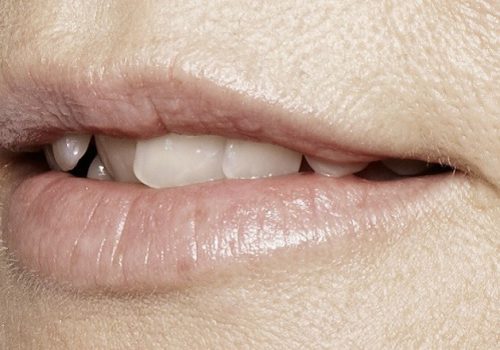 behandelingen - injectables - Lip smoothie fillers na