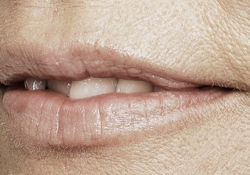 behandelingen - injectables - Lip smoothie fillers voor