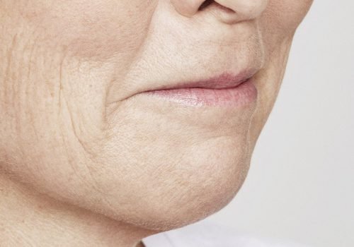 behandelingen - injectables - lippen opvullen - Lippen opvullen foto's voor