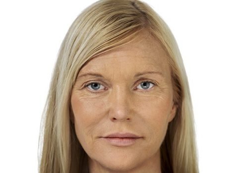 behandelingen - injectables - Liquid facelift Breda na