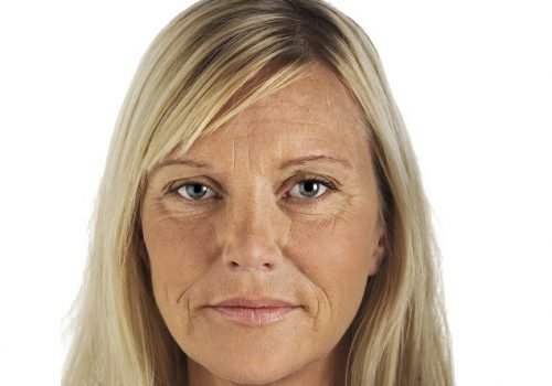 behandelingen - injectables - Liquid facelift Breda voor