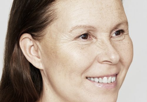 Skinboosters vrouw na