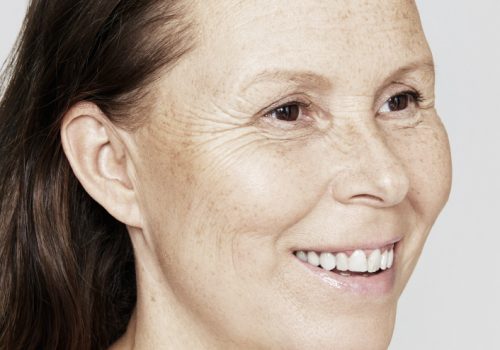 Skinboosters vrouw voor