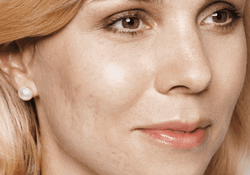 behandelingen - huidverbetering - Acne litteken behandeling voor
