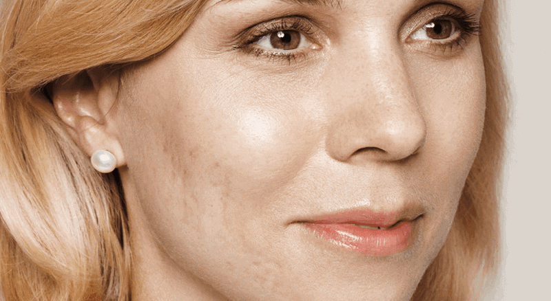 behandelingen - huidverbetering - Acne litteken behandeling voor