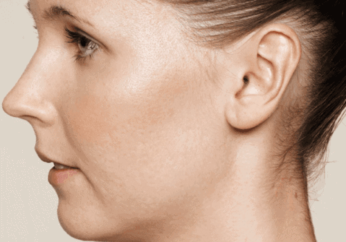 behandelingen - huidverbetering - Behandeling acne littekens na