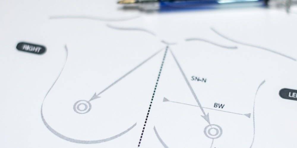 Behandelingen - borstcorrectie - Borstverkleining, borstlift zonder prothese. ronde borstimplantaten, druppelvormige borstimplantaten