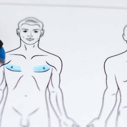 Behandelingen - borstcorrectie - Borstverkleining man