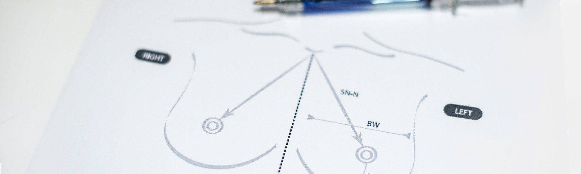 Behandelingen - borstcorrectie - Borstverkleining, borstlift zonder prothese