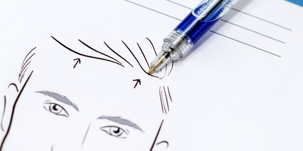 behandelingen - gezicht - facelift - voorhoofdslift