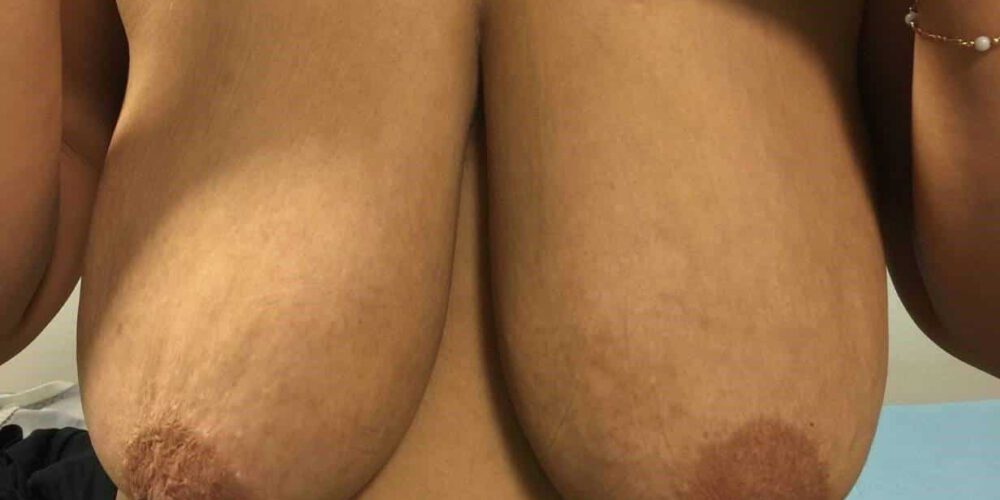 behandelingen - borstcorrectie - Borstlift foto's voor