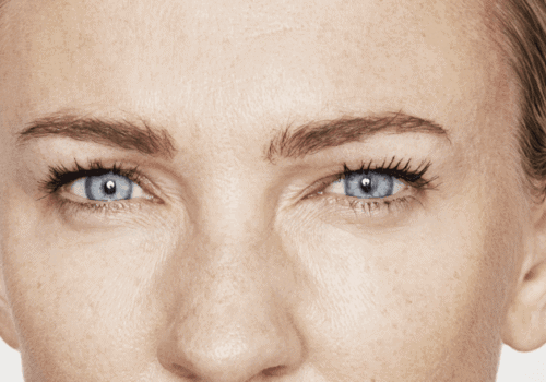 behandelingen - injectables - Botox Amsterdam na