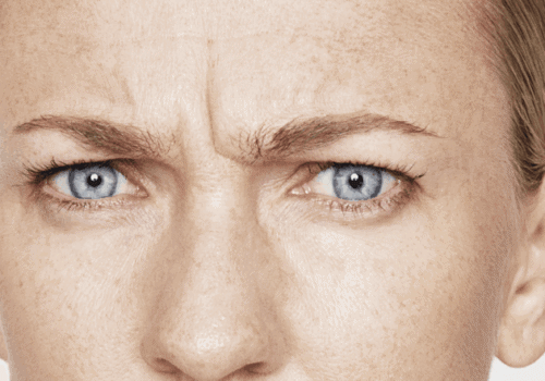 behandelingen - injectables - Botox Amsterdam voor
