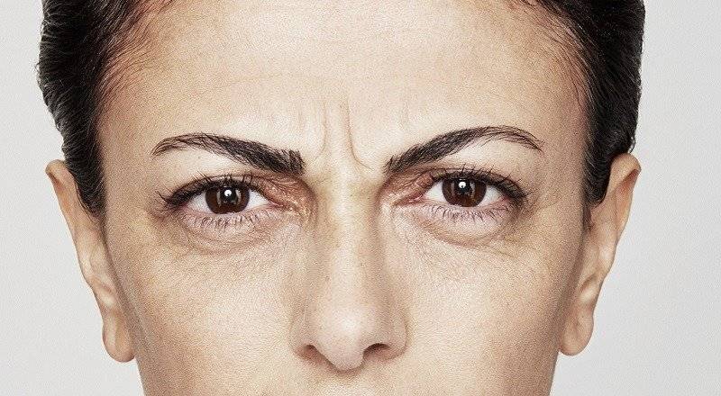 behandelingen - injectables - Botox-behandeling boze blik voor