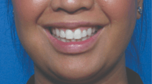 Behandelingen - injectables - Gummy smile botox na