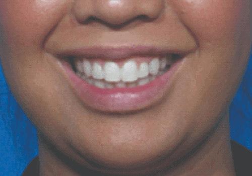 Behandelingen - injectables - Gummy smile botox na