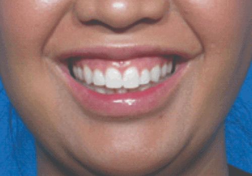 behandelingen - injectables - Gummy smile botox voor