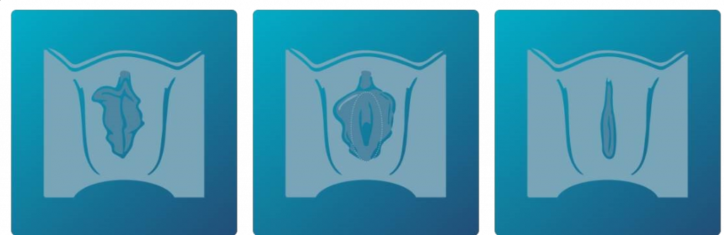 Schaamlipcorrectie - schaamlipverkleining - labiacorrectie - labiaplastie - te grote schaamlippen