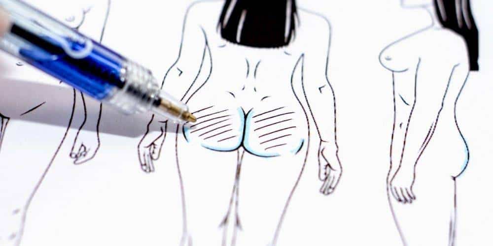 behandelingen - liposuctie - lipofilling - billen
