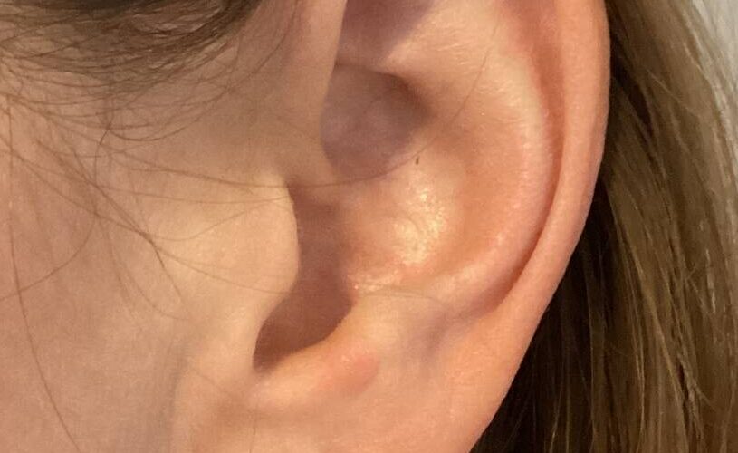 oorlelcorrectie voor