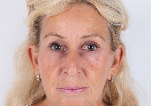 Resultaat Botox-behandeling fronsrimpel Patricia