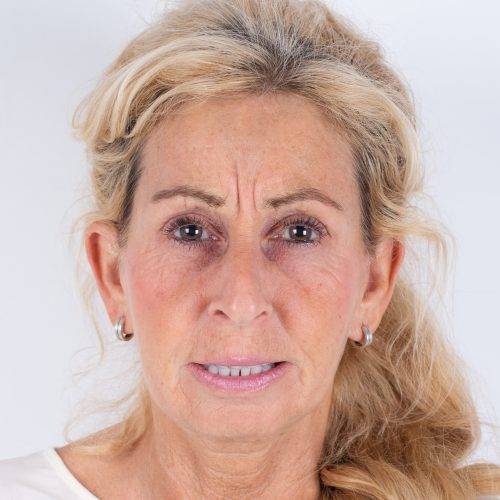 Botoxbehandeling fronsrimpel Patricia