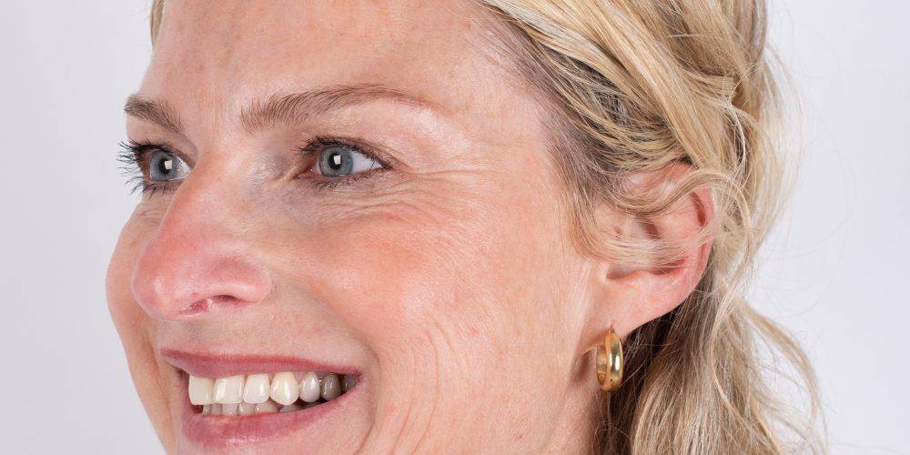 Behandeling kraaienpootjes bij Inge met Botox