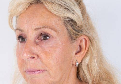 Resultaat behandeling fronsrimpel met de Botuline toxine Azzalure Patricia