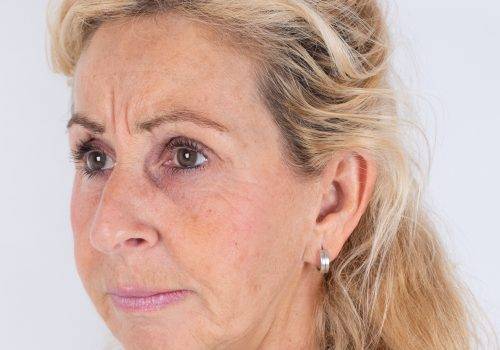 Behandeling Botuline toxine Patricia fronsrimpel