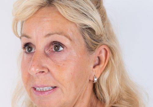 Resultaat van een Botox-behandeling voorhoofdsrimpels Patricia