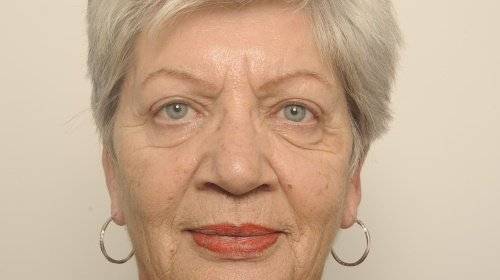 Bovenooglidcorrectie behandeling Corry na