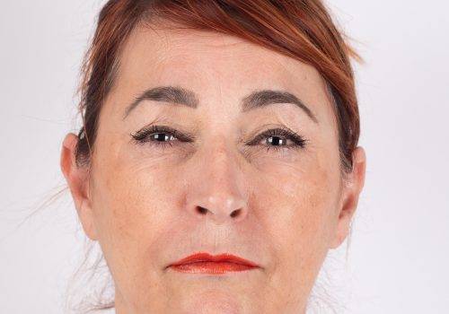 Fronsrimpel met Botox resultaat